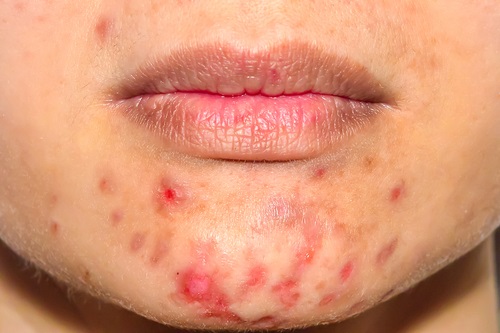 Western diet associated with adult acne