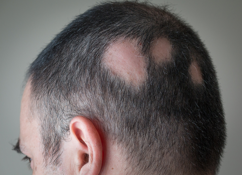 Novel use of an old systemic: Cyclosporine for Alopecia Areata