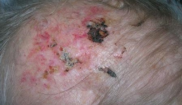 Are you missing this scalp presentation? Erosive pustular dermatosis of the scalp (EPDS)