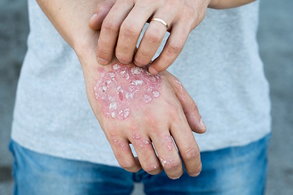 Should we be screening psoriasis patients for cancer?