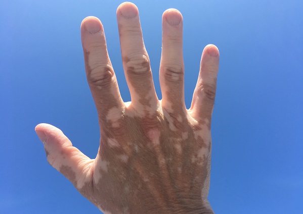 Vitiligo’s impact beyond the skin