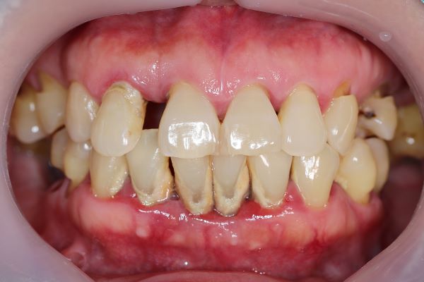 Gum disease as indicator of skin disease
