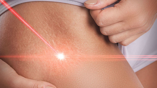 Does Fractional Laser Treatment Improve Stretch Marks?