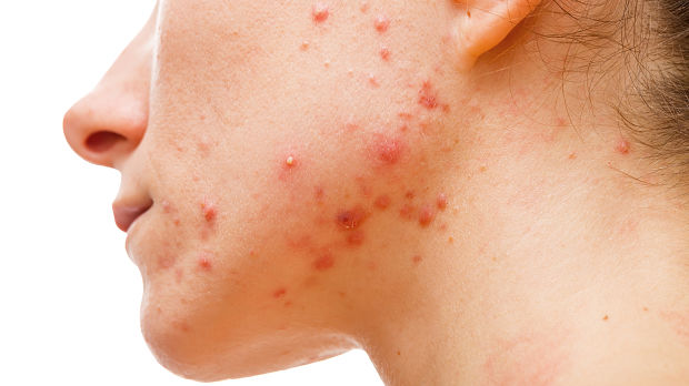 Acne severity and food: Hold the pizza!