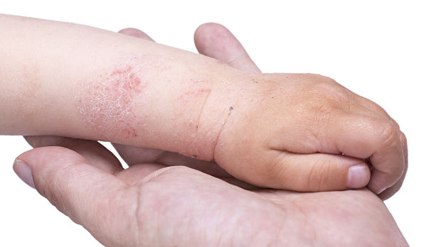 Are Systemic Corticosteroids Really Safe and Effective for Treating Atopic Dermatitis?