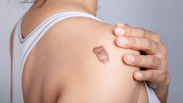 Pediatric Keloids More Common Than Previously Thought
