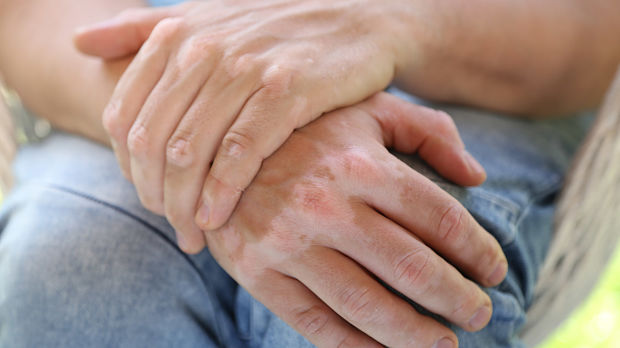 Which Comorbidities Most Commonly Accompany Vitiligo?