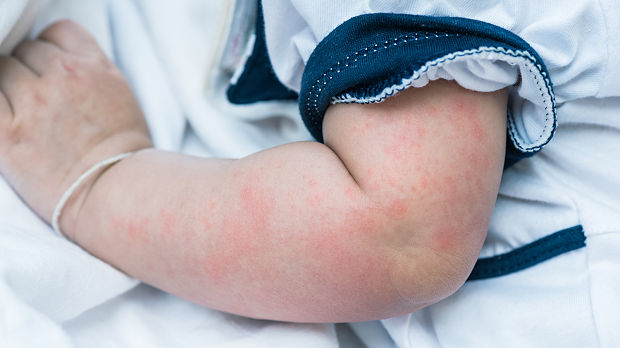 Chronic Urticaria in Children: Can We Predict Resolution?