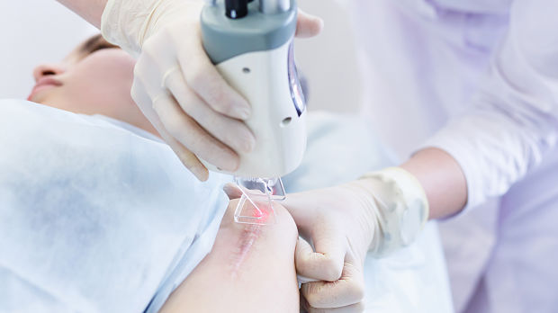 Do Lasers Really Minimize Scar Formation?