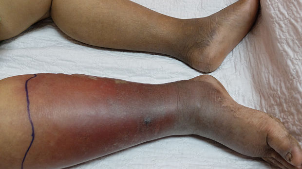Do Derm Consults Reduce Cellulitis Hospital Stays and/or Antibiotic Use?