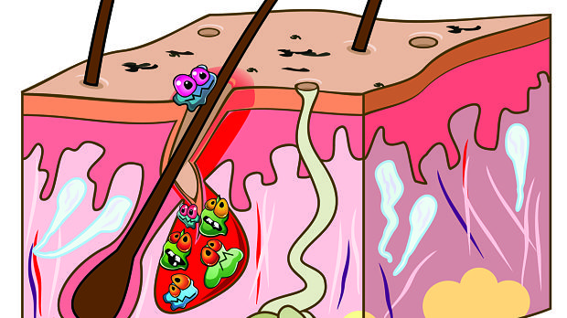The Pediatric Microbiome and Acne, Different Than Adults?